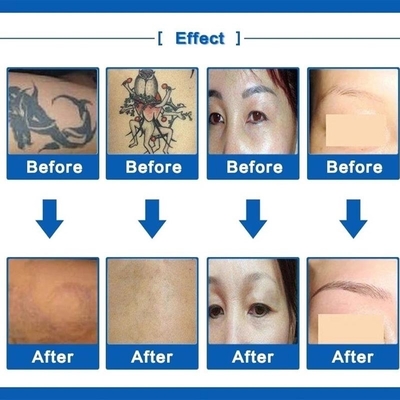 Remoção comutada Q 110V/220V da sarda da máquina da remoção da tatuagem do laser do Nd Yag
