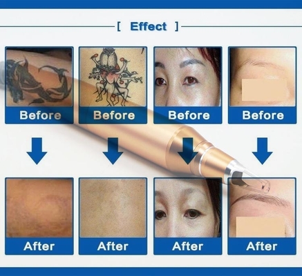 Da máquina comercial da remoção da tatuagem do interruptor do OEM Q laser branco do ND Yag da cor